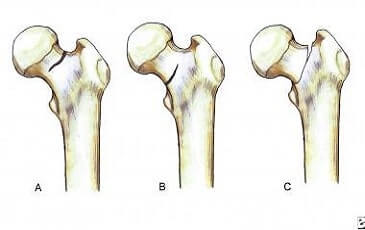 Fracture Treatment in Hyderabad