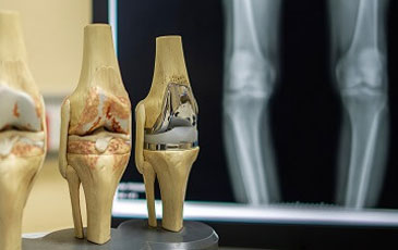 Hip Replacement Surgeon in Hyderabad