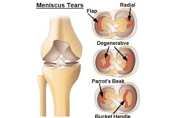 Knee Joint Arthroplasty